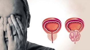 cauzele prostatitei la bărbați