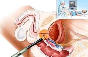 modalități de diagnosticare a prostatitei