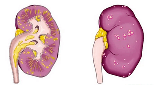 ce cauzează prostatita acută