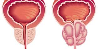 prostatita