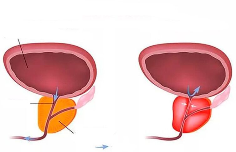 prostata normala si inflamata