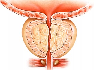 Prostatita