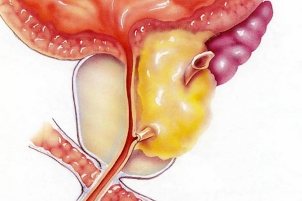 prostatita